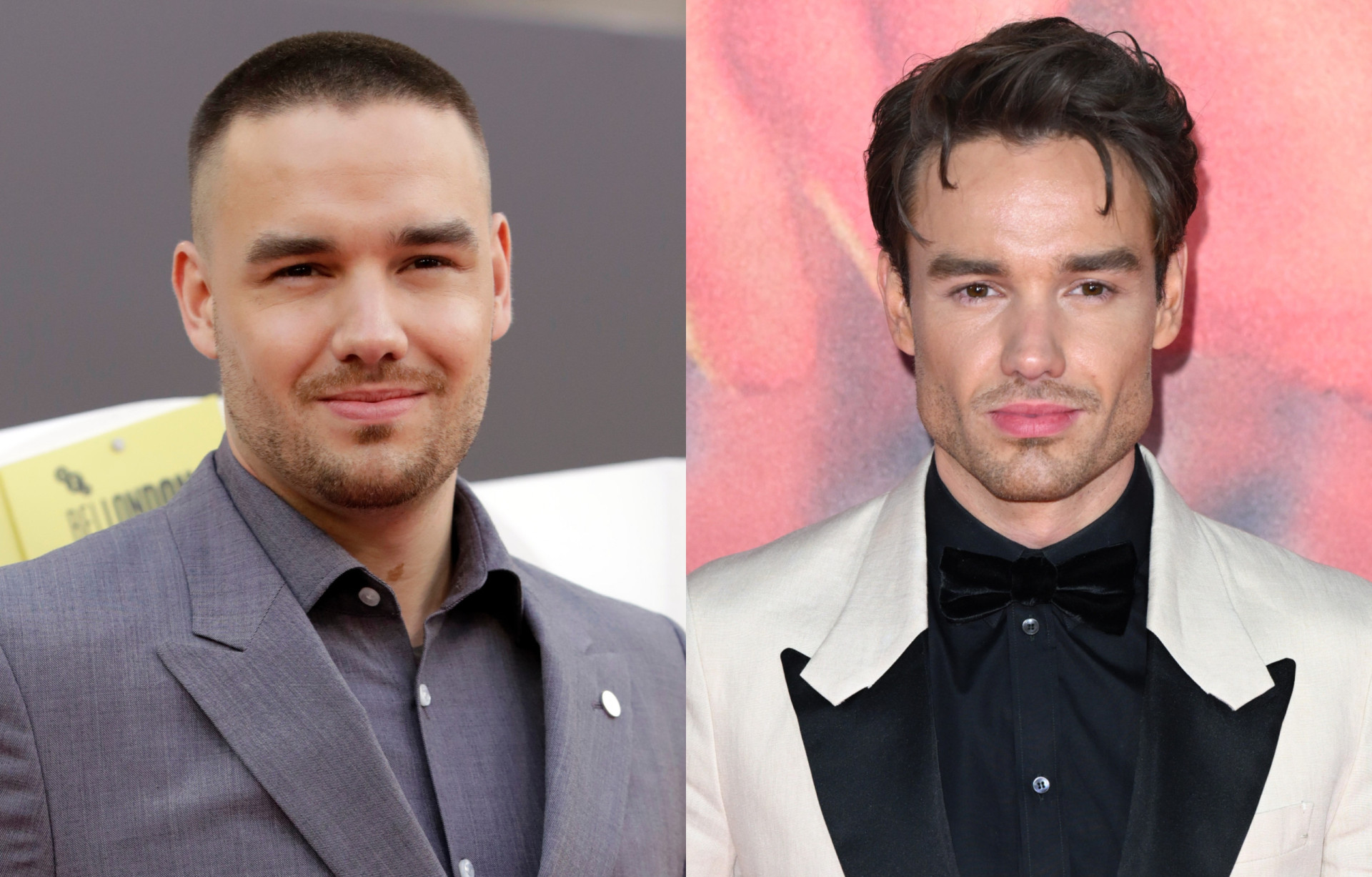 Cirurgia estética Fãs em alerta devido a mudanças na cara de Liam Payne